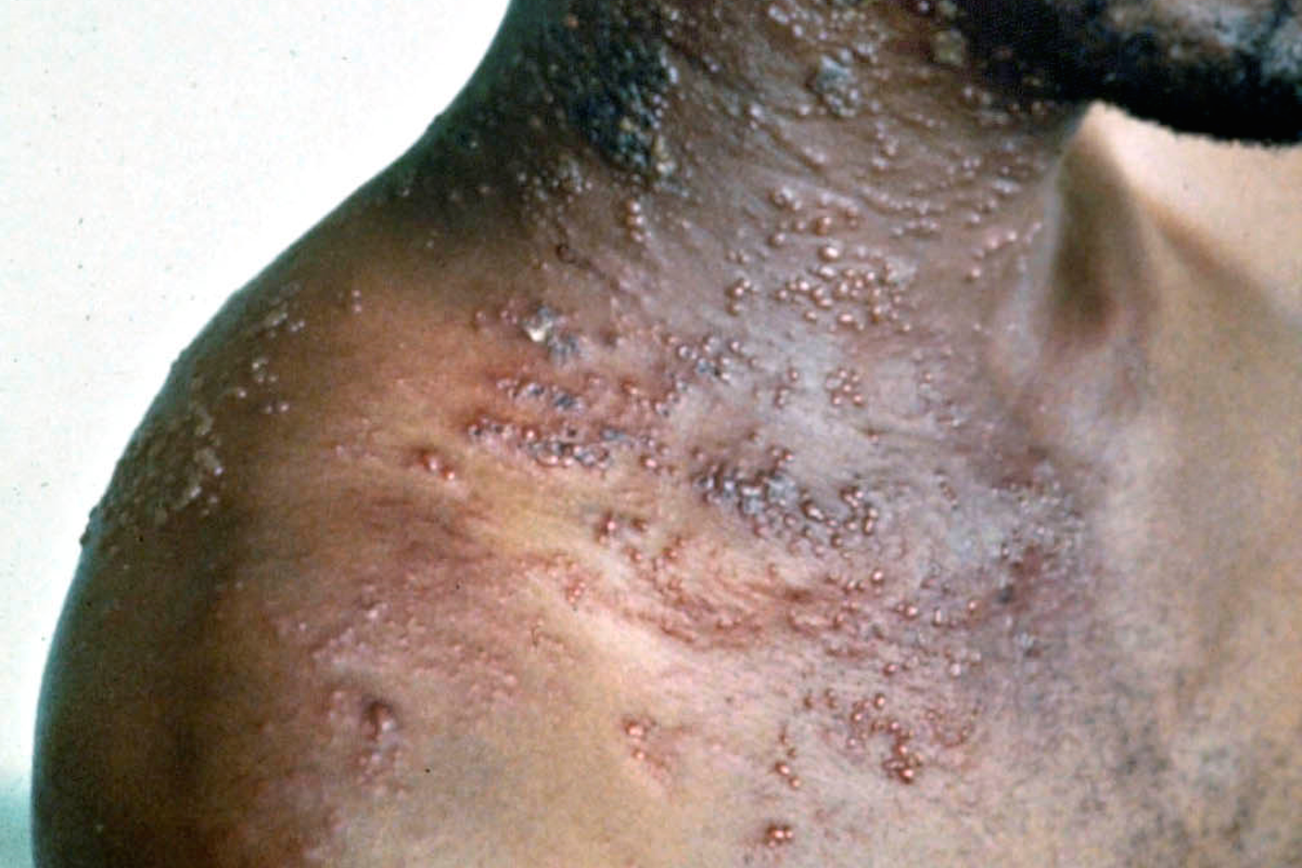 anal Shingles rash and Canadian double penetration